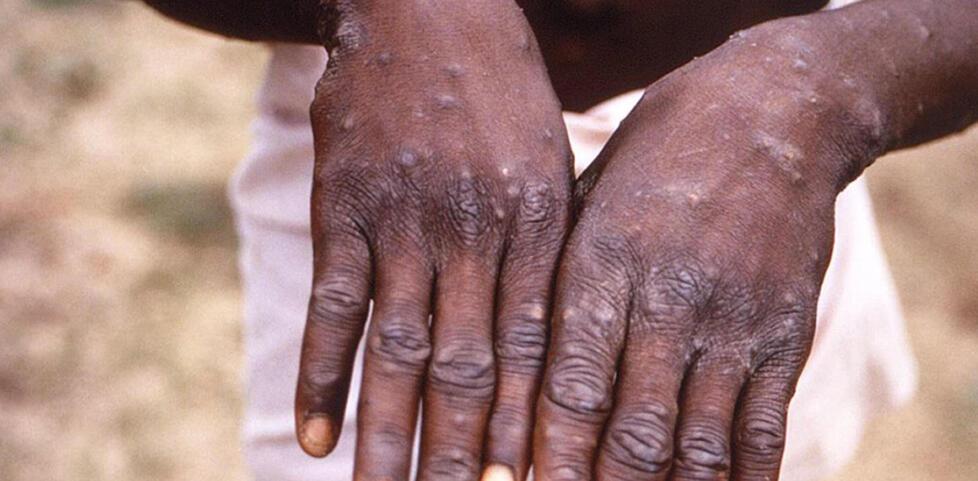 Vaiolo scimmie, due casi sospetti a Ferrara