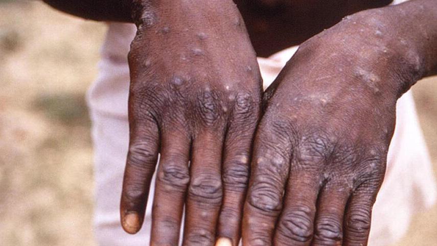 Vaiolo scimmie, due casi sospetti a Ferrara