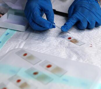 Test del sangue per verificare la presenza del virus del vaiolo delle scimmie (foto archivio Ansa)