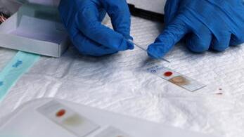 Test del sangue per verificare la presenza del virus del vaiolo delle scimmie (foto archivio Ansa)