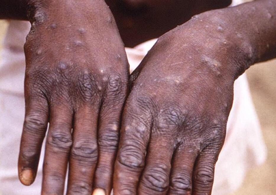 Nella foto, le tipiche eruzioni cutanee che si riscontrano in chi è affetto da vaiolo delle scimmie