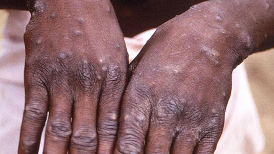 Nella foto, le tipiche eruzioni cutanee che si riscontrano in chi è affetto da vaiolo delle scimmie