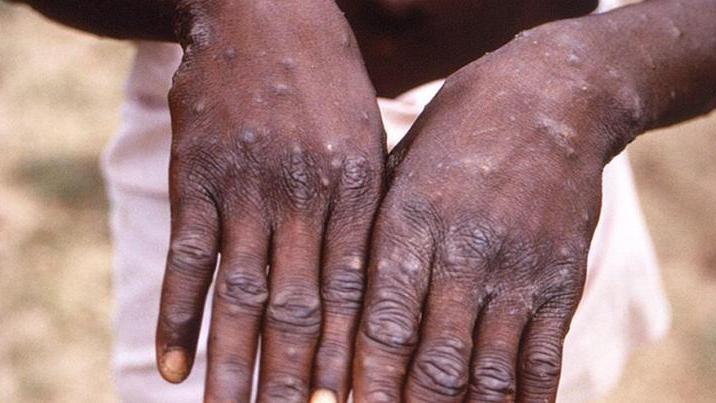 Vaiolo delle scimmie: al via da oggi in Emilia le prime vaccinazioni