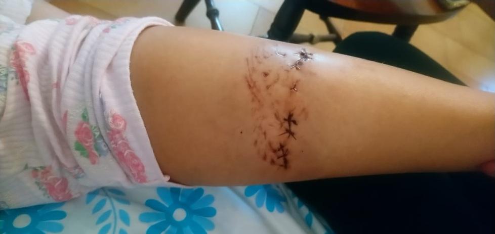 Carpi. «Mia figlia azzannata dal pitbull della vicina» 
