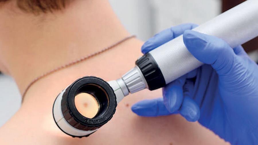 Crescono i casi di melanoma: in un anno sono 600 in più. Il dottor Borgognoni: «Serve prevenzione»