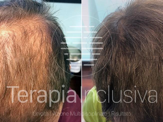 Comunicato Stampa: Calvizie, la Medicina Rigenerativa Inclusiva è la nuova frontiera.