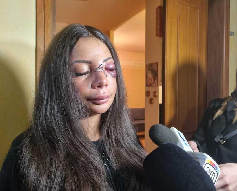 Prato, barista sfregiata: si rafforza la pista del pestaggio su commissione