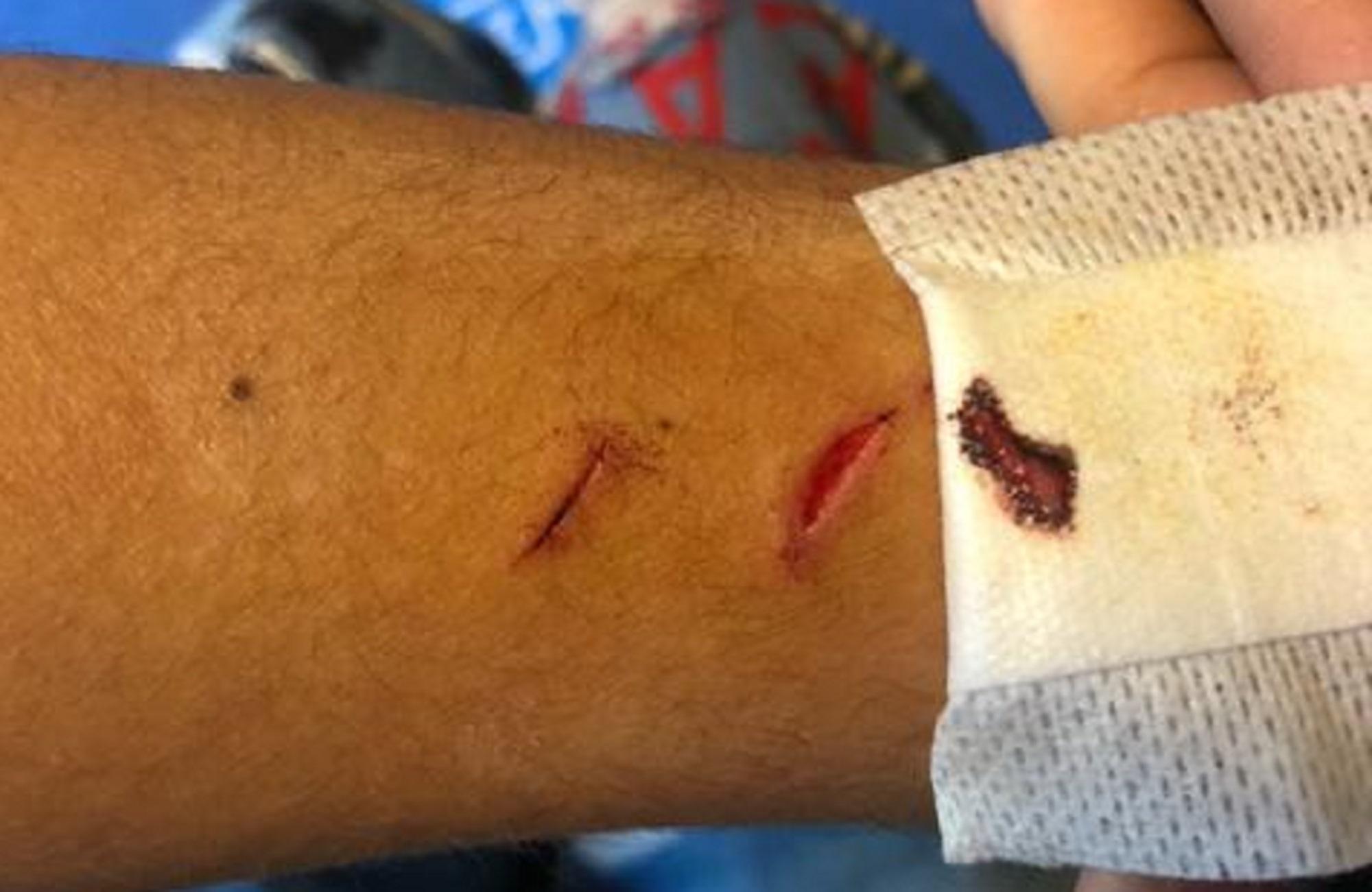 Accoltellato e rapinato a 13 anni, la rabbia del padre: «Corea un quartiere pericoloso» 