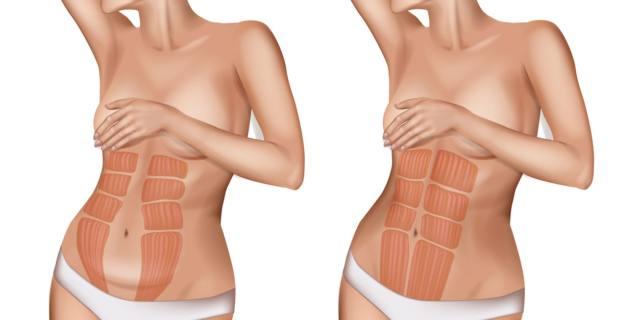 Diastasi addominale: primo intervento riparatore in provincia di Reggio Emilia