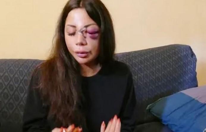 
	Martina Mucci coi segni della brutale aggressione sul volto

