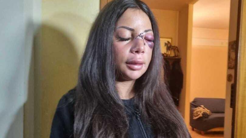Martina Mucci nei giorni successivi all’aggressione