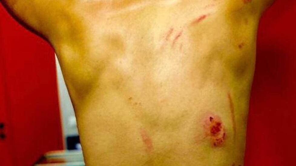 Pisa, reagisce al morso di un cane e viene picchiato: coppia denunciata per lesioni aggravate