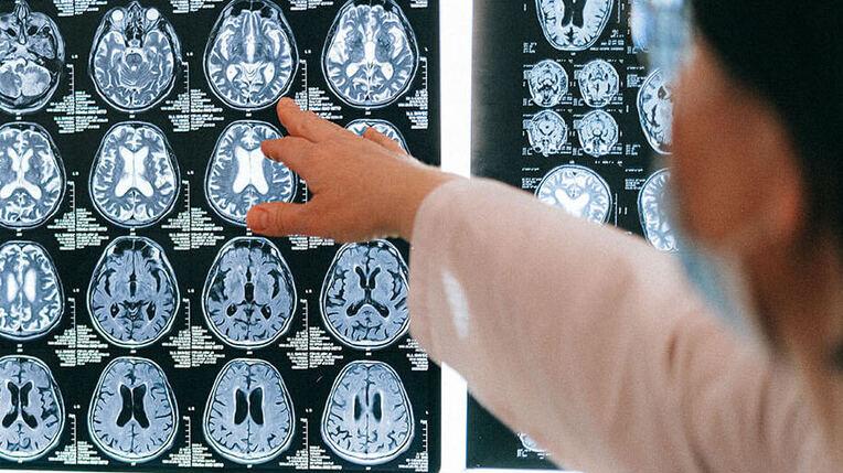 Lucca, un 32enne salvato da una malformazione cerebrale. «Nel privato pochi operano, troppi i rischi»