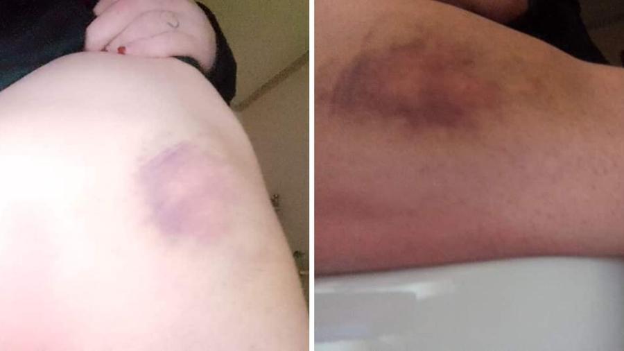
	Due foto dei lividi diffuse&nbsp;dalla donna

