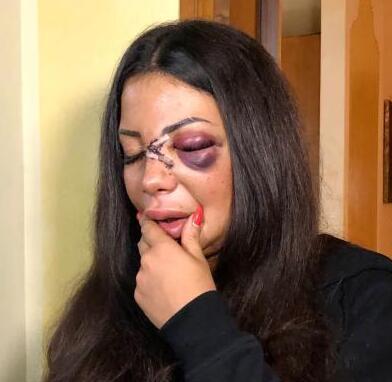 Martina Mucci, la barista sfregiata a Prato: «Dopo l'incubo sono tornata a vivere ma per un amore è presto»
