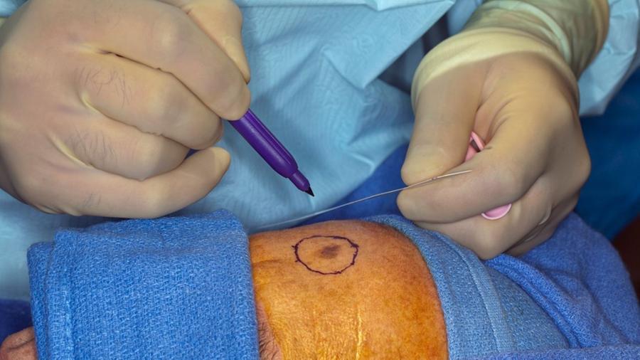 Sarah Ferguson e il melanoma, gli esperti: «Spinta per la prevenzione». Nei: attenzione ai “brutti anatroccoli” e alla regola dell’Abcde