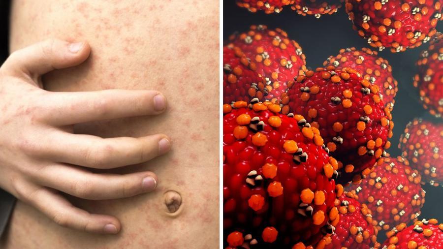 Morbillo, in Toscana impennata di casi anche nei bambini: i sintomi, i vaccini e come “lavora” il virus