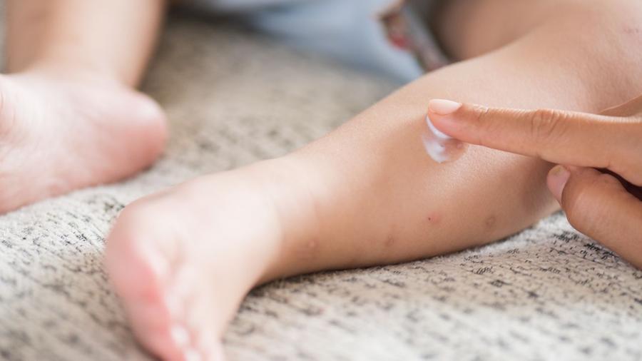 Morbillo, boom di casi tra Pisa e provincia: il contagio, i sintomi e chi è più a rischio