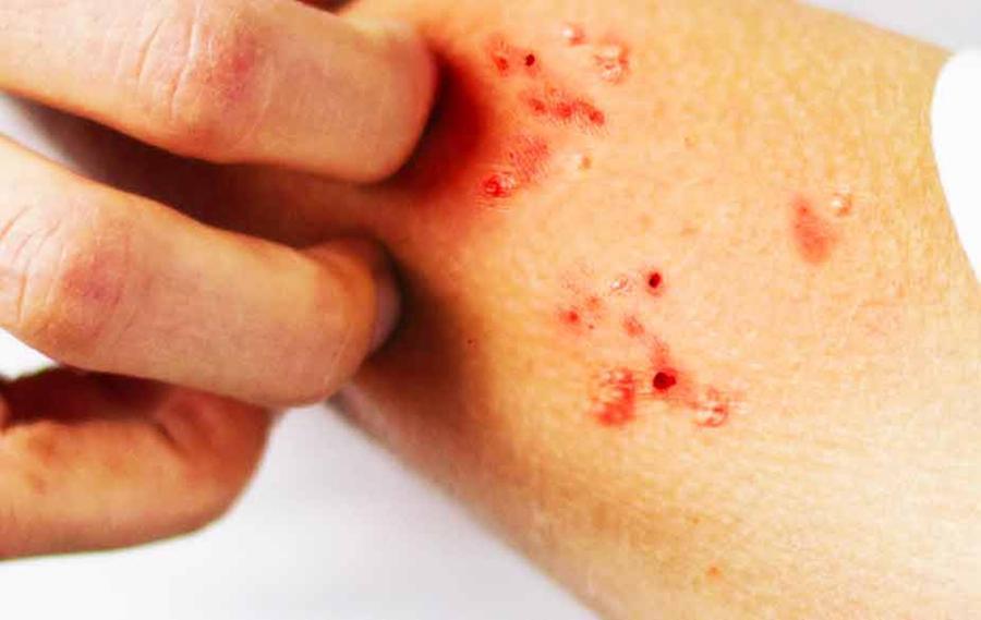 Pontedera, un caso di scabbia al liceo: è il secondo in pochi mesi, i sintomi, il contagio e i rischi della malattia