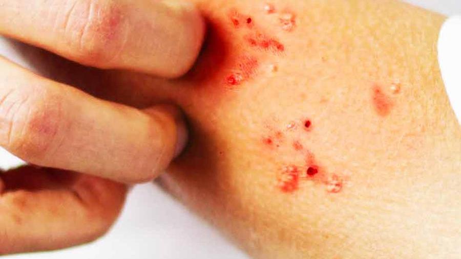 Pontedera, un caso di scabbia al liceo: è il secondo in pochi mesi, i sintomi, il contagio e i rischi della malattia