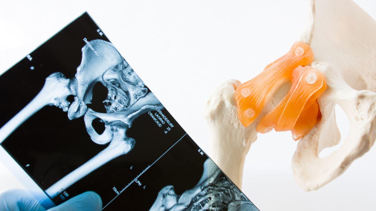 Displasia dell'anca, piede torto, ginocchio valgo e morbo di Osgood Schlatter: cosa fare e quando preoccuparsi per i nostri figli
