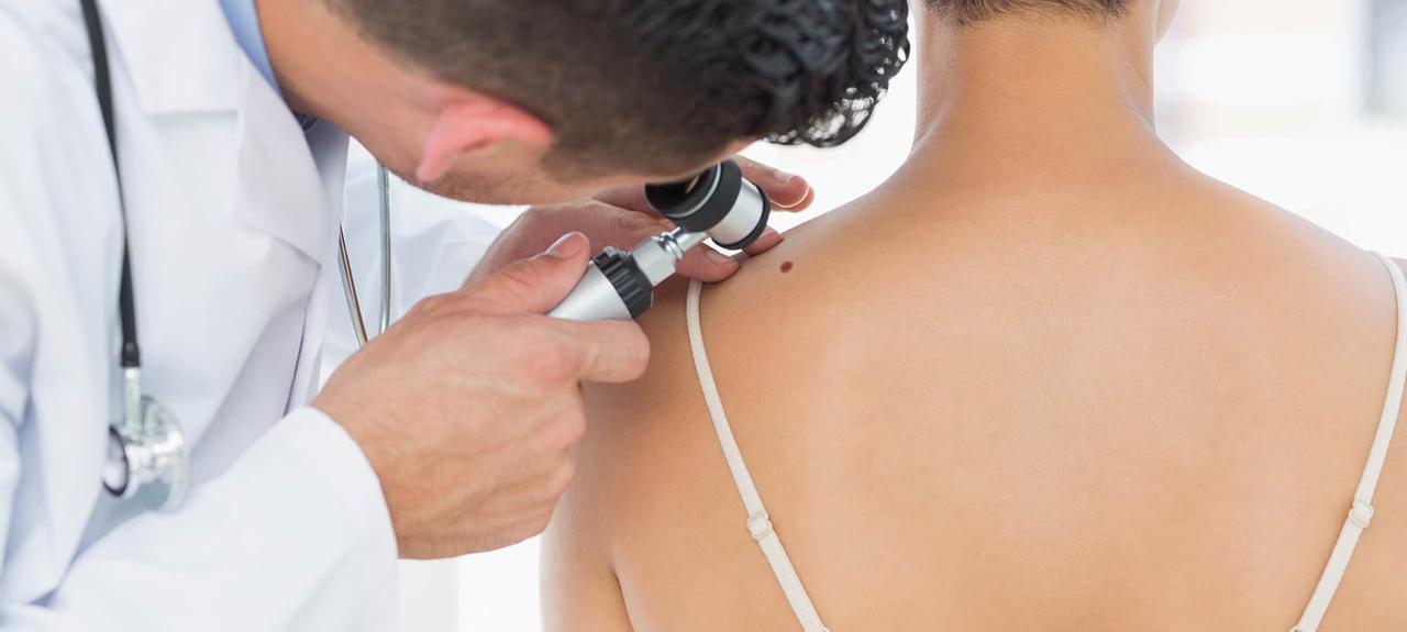 Melanoma, casi in aumento in Toscana: 1.600 in più nell’ultimo anno. Il “record” di Livorno