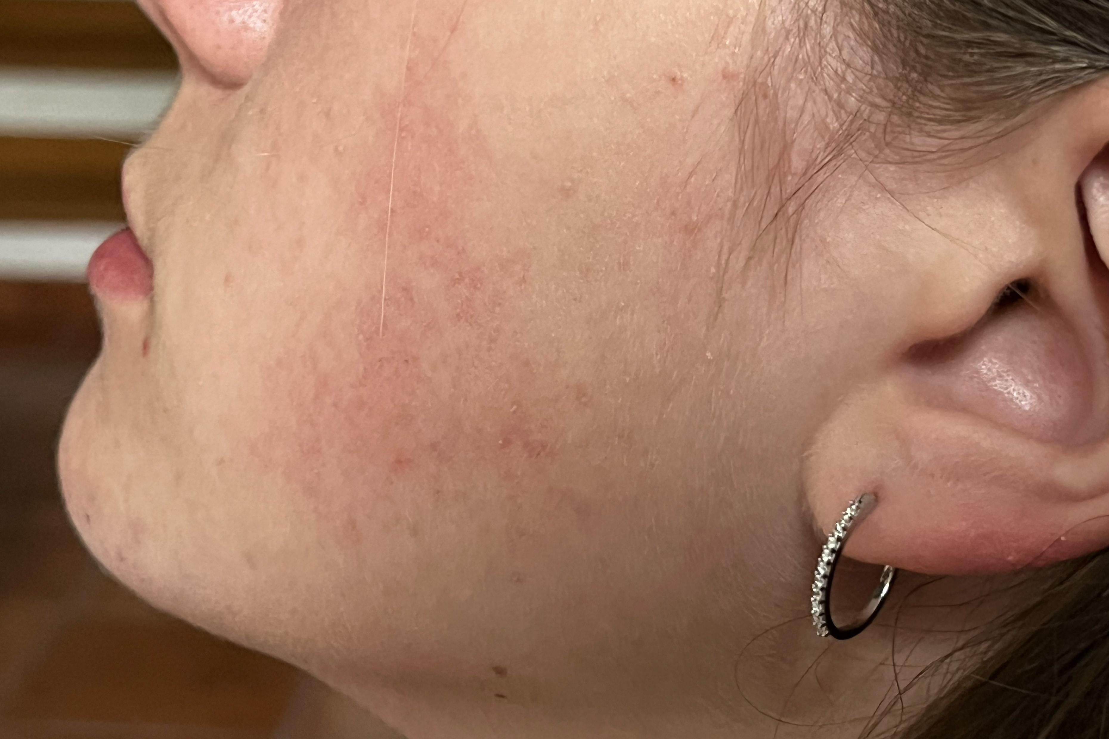 Ferrara, tanti bambini a casa da scuola per un’epidemia di quinta malattia