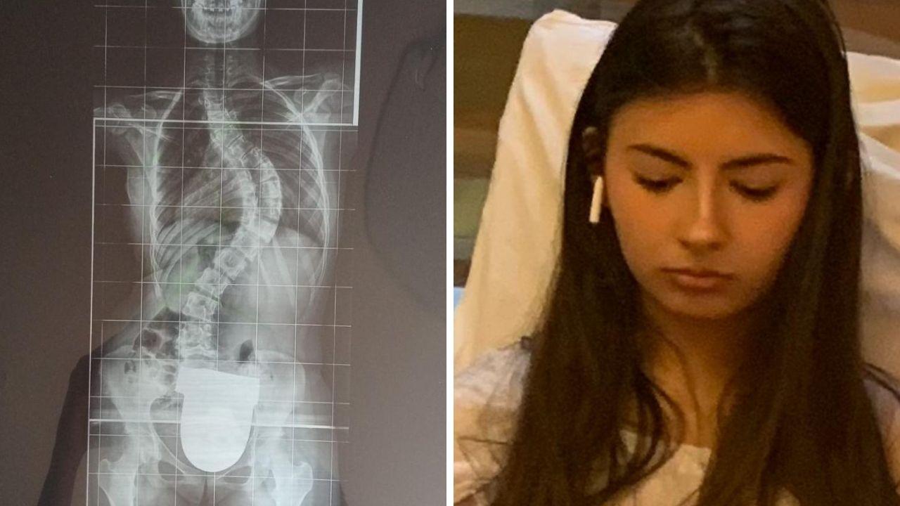 
	La radiografia con la grave scoliosi e la 14enne Ginevra Bongianni

