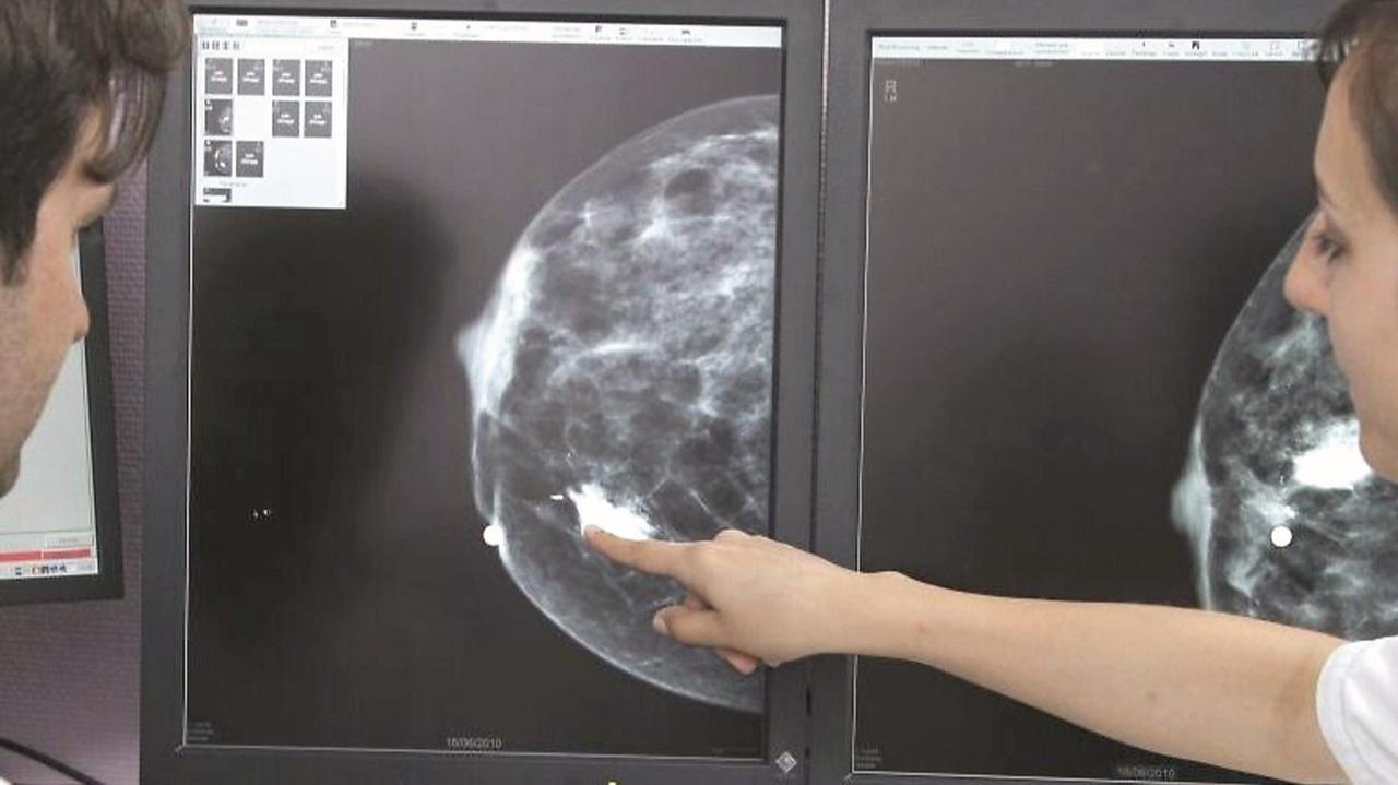 Liste d’attesa infinite ma gli screening gratuiti funzionano solo al 50%