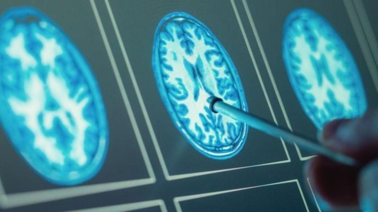 A Pisa scoperto il farmaco che aiuta a diagnosticare i tumori al cervello