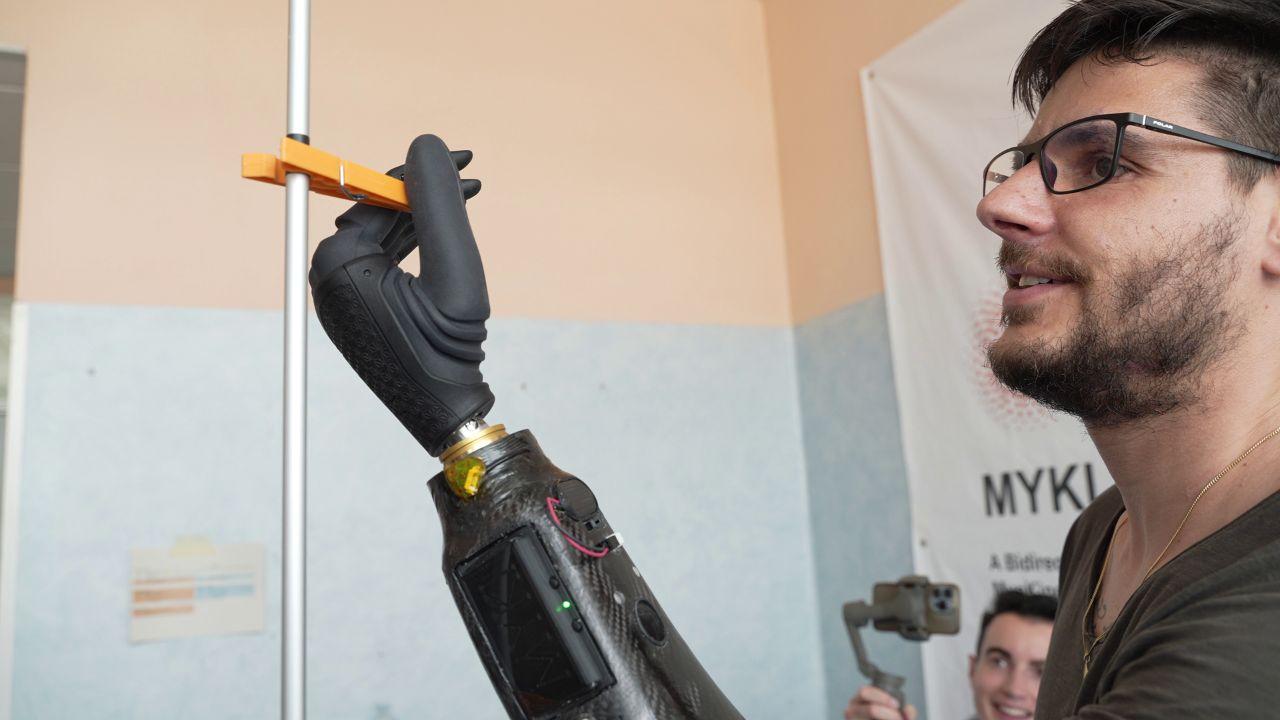 La prima protesi al mondo a controllo magnetico
