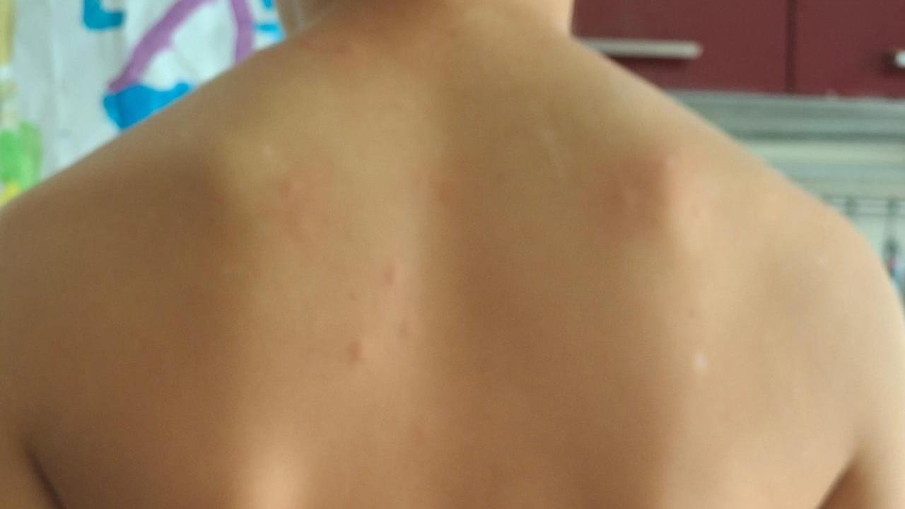 Strane punture sulla pelle a Ferrara. Le farmacie: «Molti casi in città»