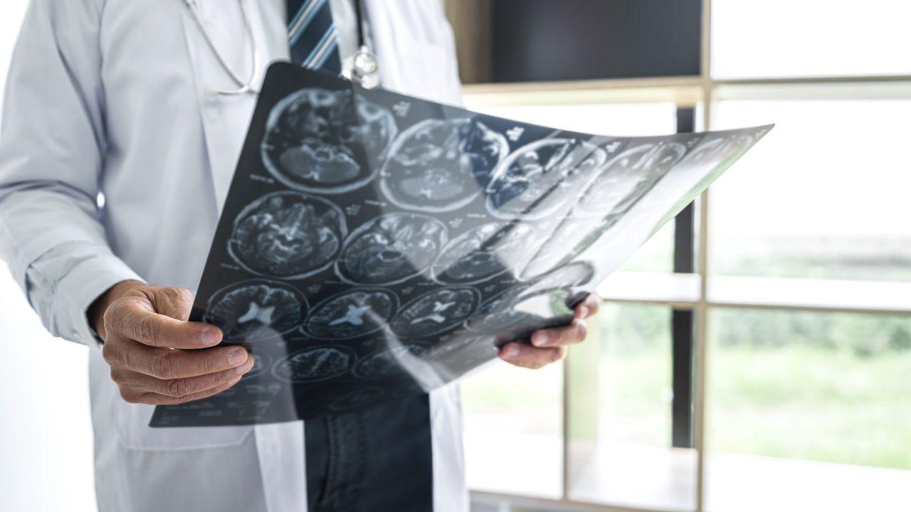 Svolta nella ricerca sull'Alzheimer