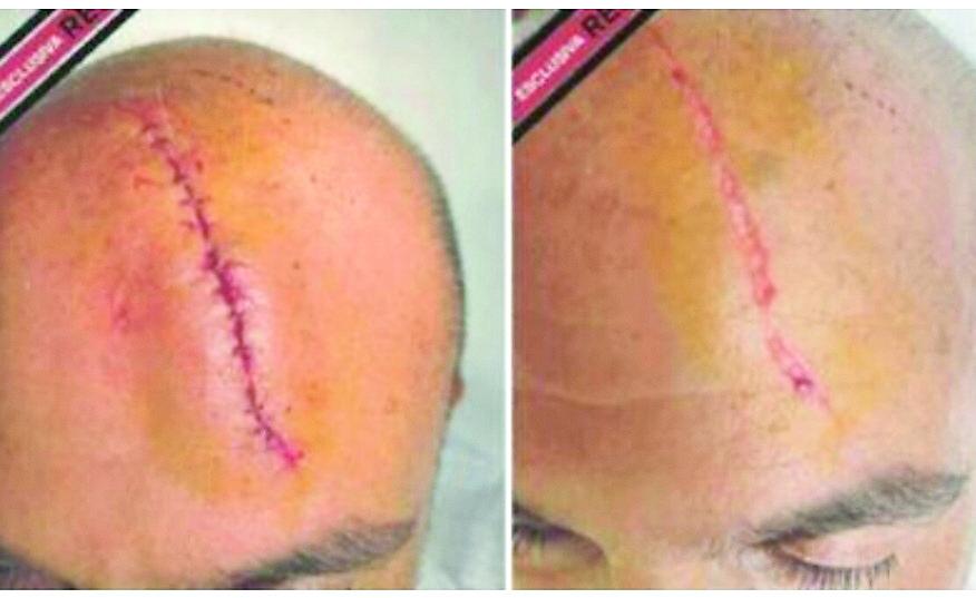 Report, le foto esclusive delle cicatrici di Sangiuliano