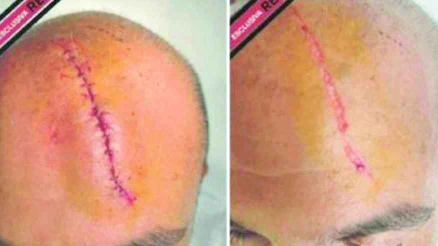 Report, le foto esclusive delle cicatrici di Sangiuliano