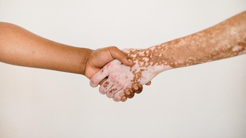 A Sassari un open day dedicato alla vitiligine