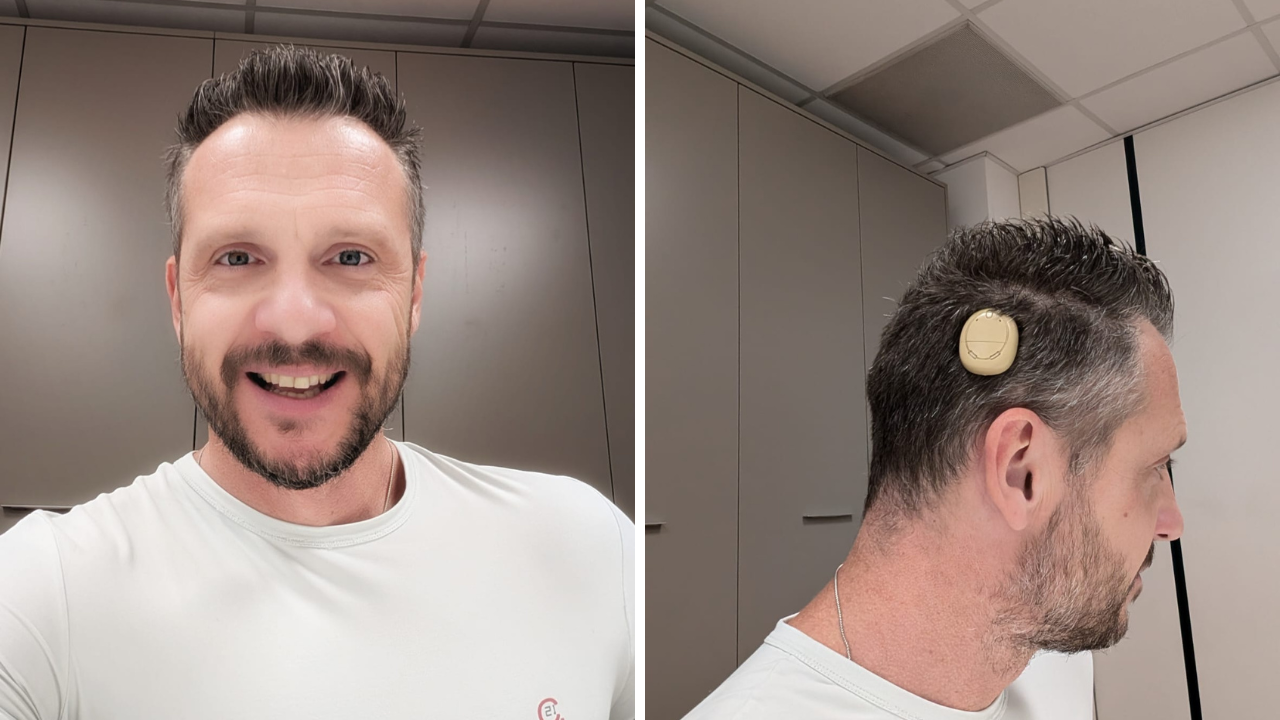 Fausto Bosco con l’impianto che gli ha ridato l’udito dopo una malattia degenerativa scoperta a 20 anni