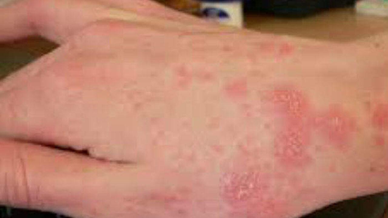 Allarme scabbia in una scuola a Sassari