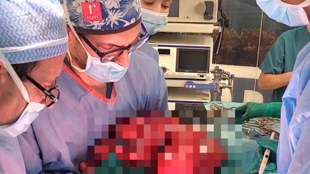 Rimosso un tumore di 12 chili: operazione record al Mater Olbia