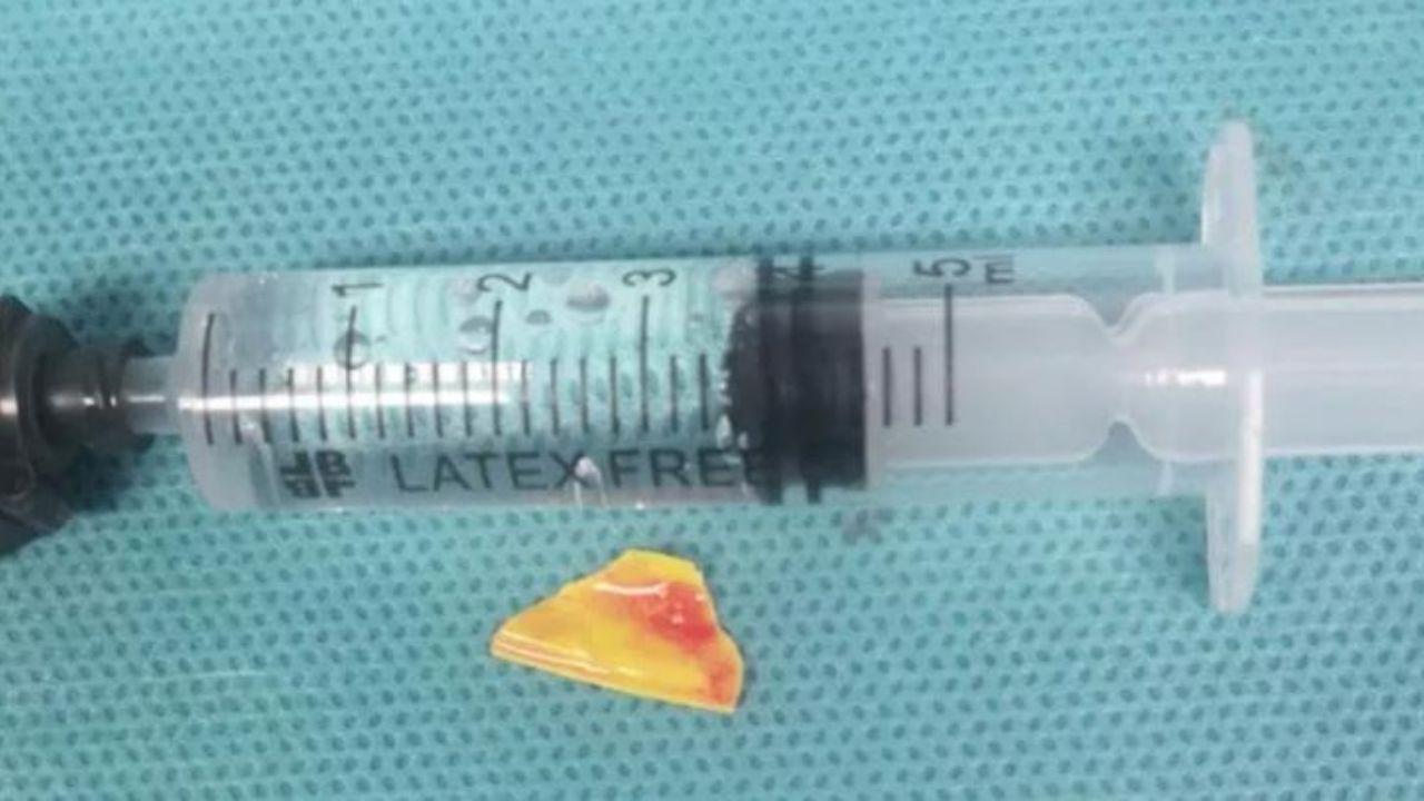 
	La scheggia rimossa dalla gola della bimba di 14 mesi

