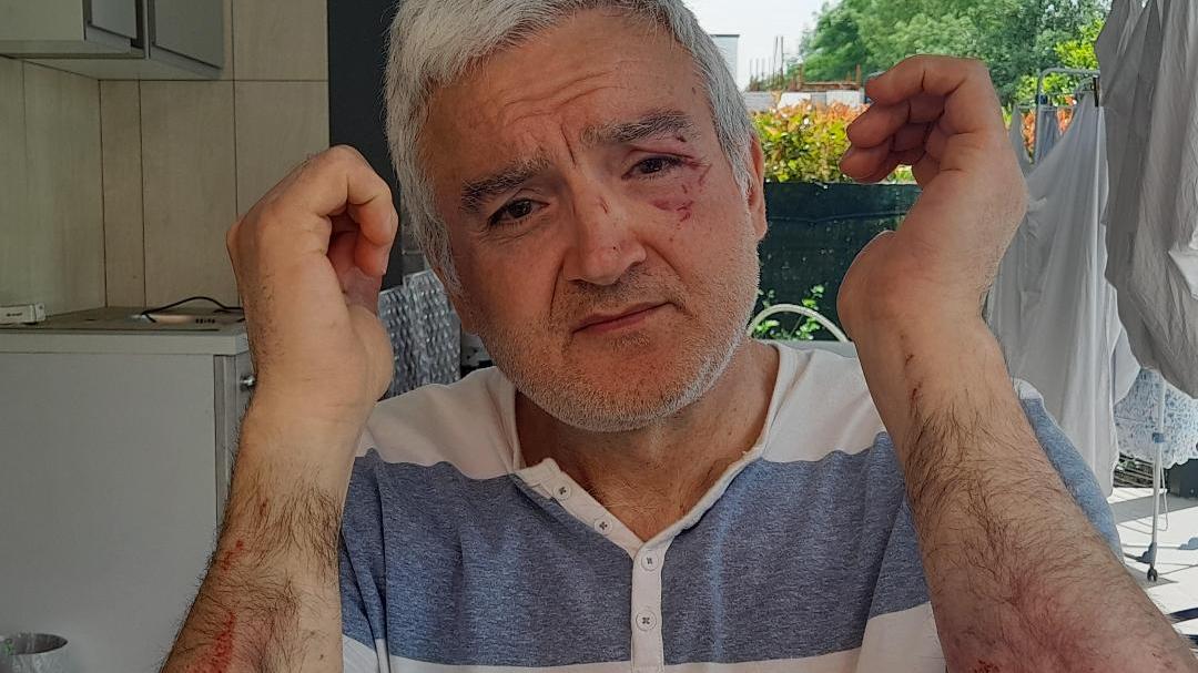Aggressione nel quartiere Acque Chiare: «Preso a badilate dal balordo che ci terrorizza da oltre un anno»