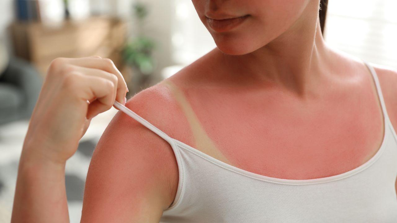 
	Le scottature da giovani che moltiplicano il rischio di avere un melanoma


