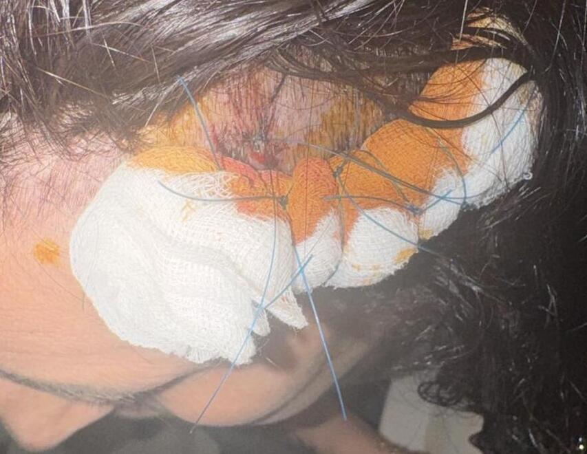 
	Le ferite alla testa dopo i morsi

