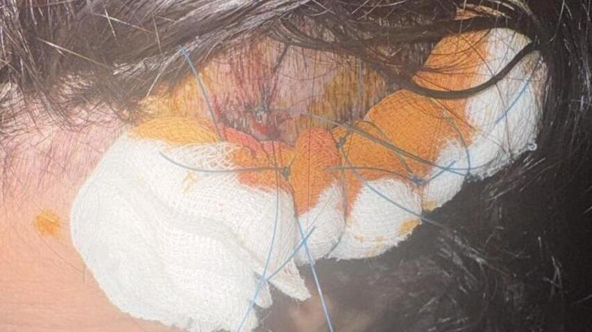 Le ferite alla testa dopo i morsi