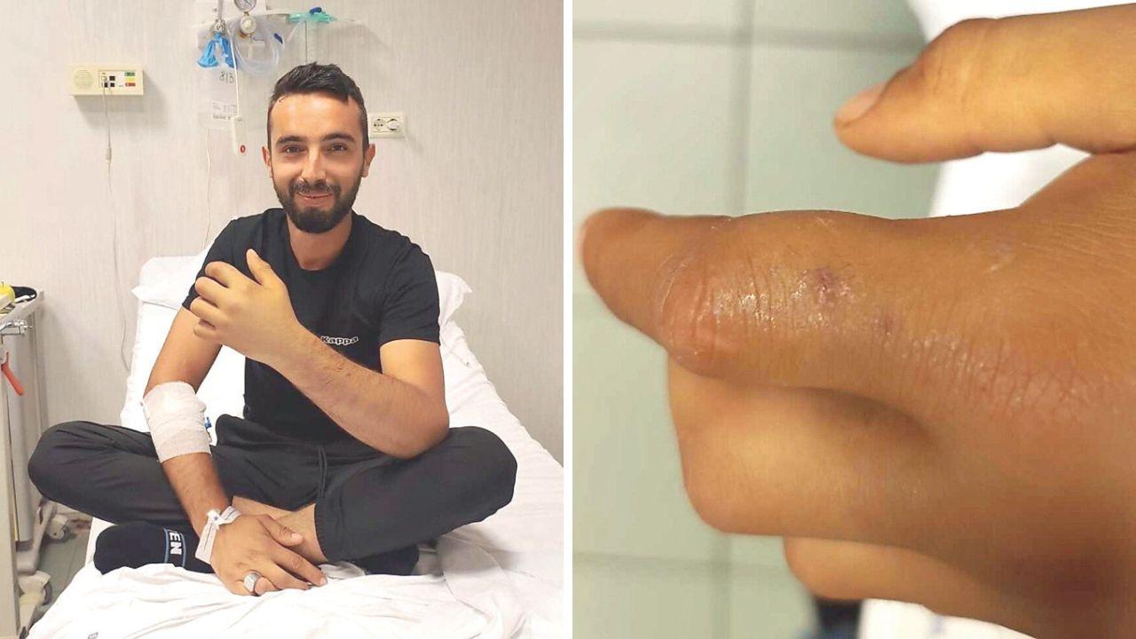 Klajdi Trimi all’ospedale di Cisanello e i segni del morso della vipera sulla mano del giovane