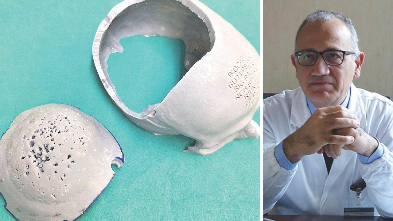 Il cranio della paziente ricostruito in laboratorio con una speciale resina e il primario