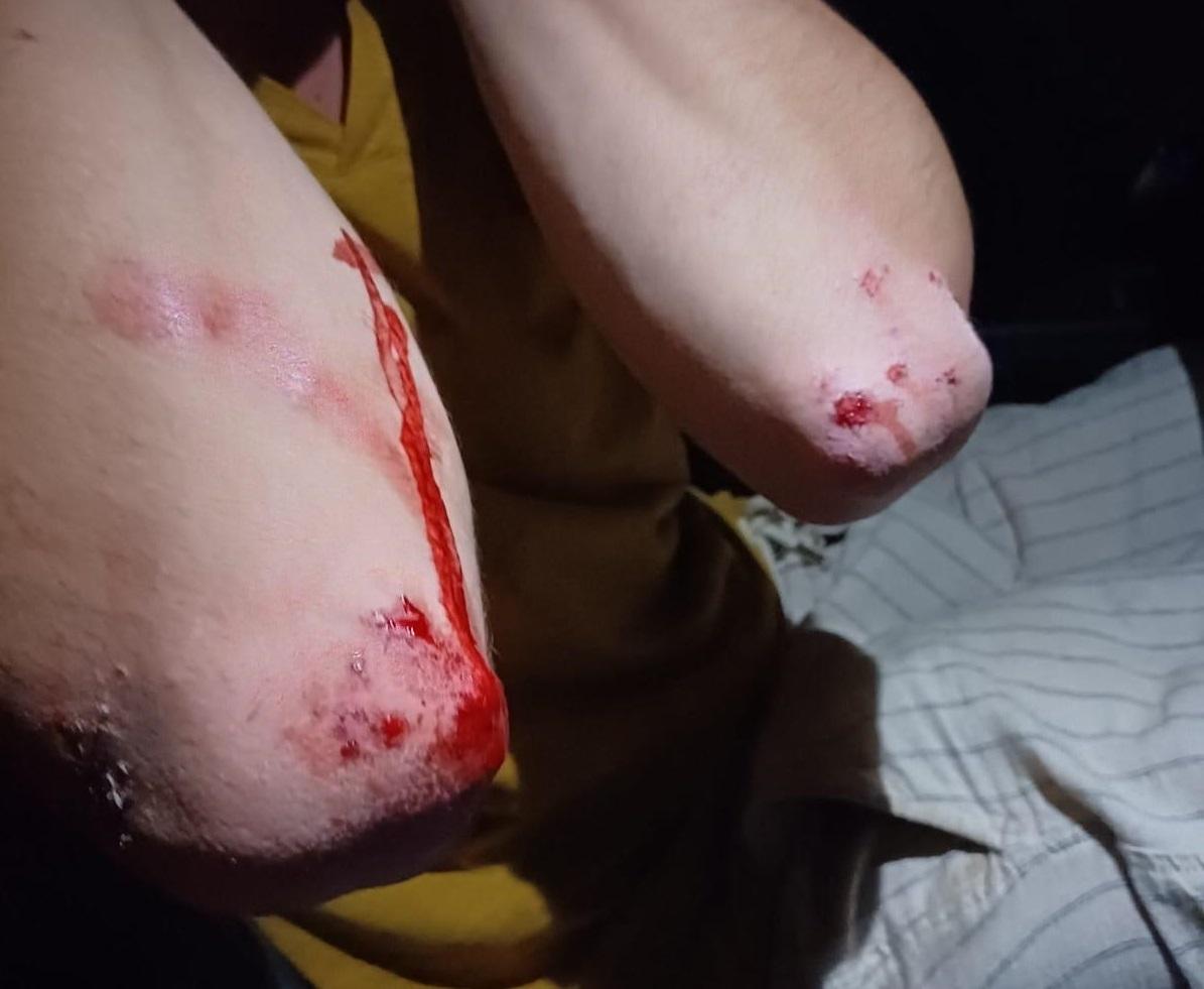 «Preso a calci e pugni dal buttafuori del locale». Scoppia il caso a Lido Spina