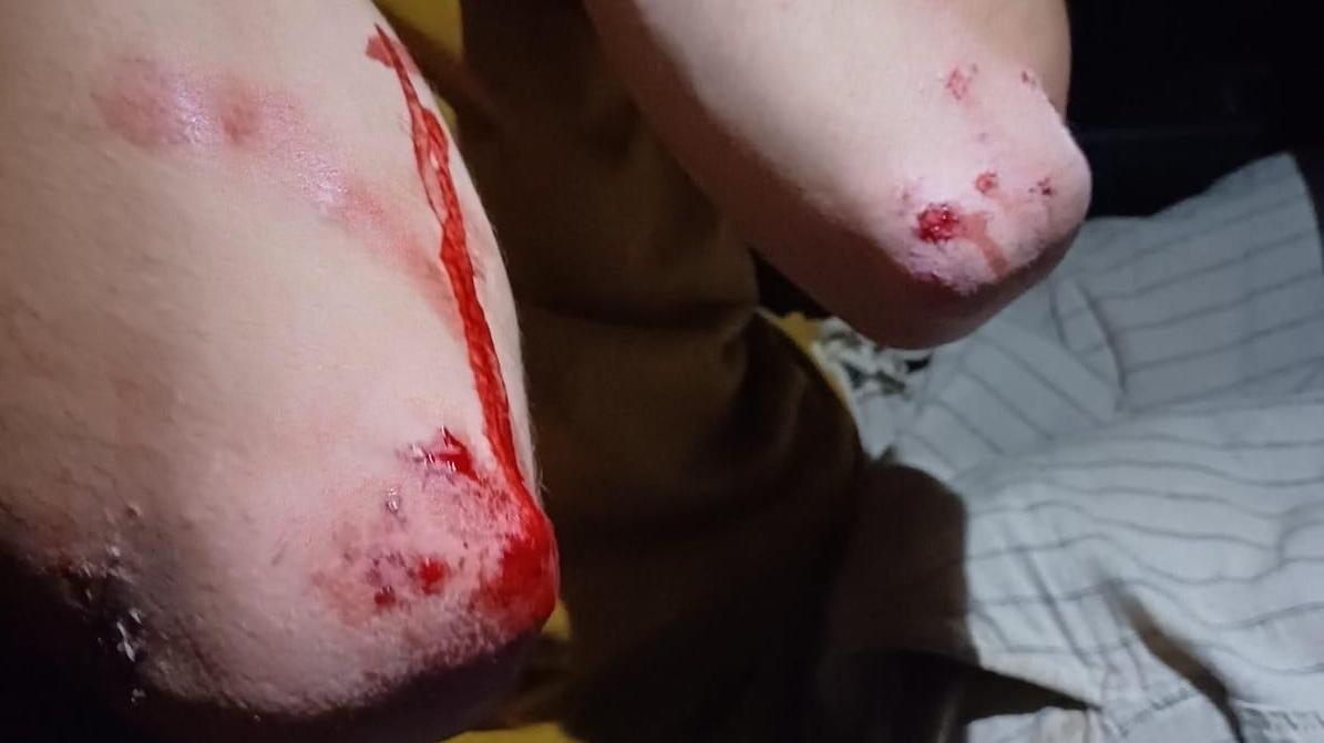 «Preso a calci e pugni dal buttafuori del locale». Scoppia il caso a Lido Spina