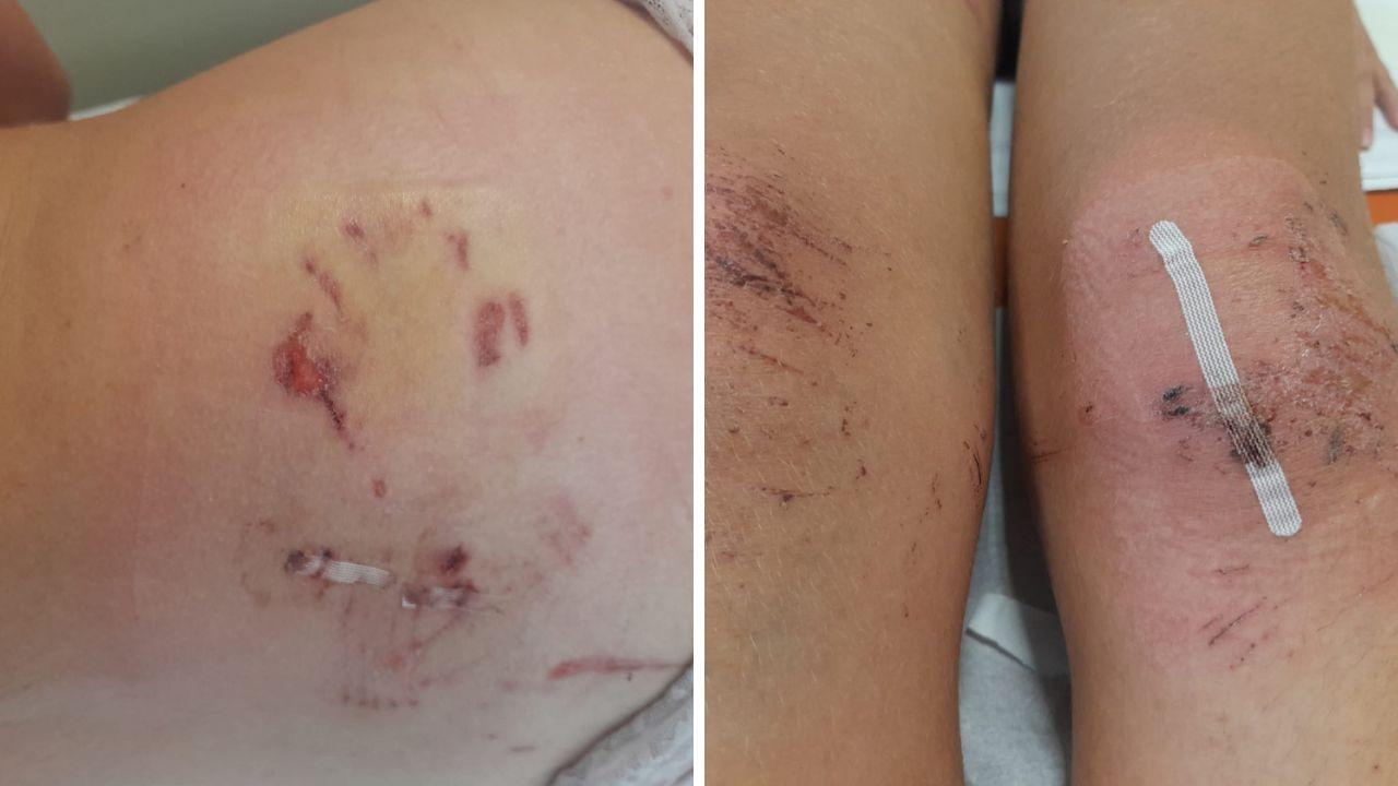 
	Alcune delle ferite riportate dalla 18enne

