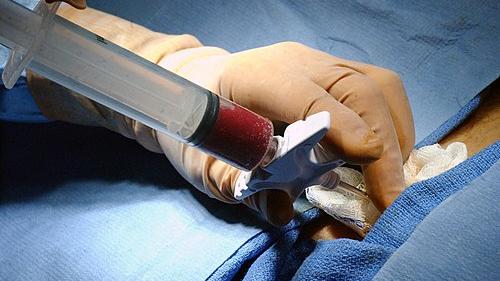 Ecco come il trapianto di midollo cambia il destino dei pazienti malati di leucemia